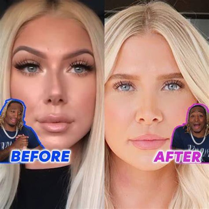 Charles And Alyssa Before And After Plastic Surgery: Everything To Know