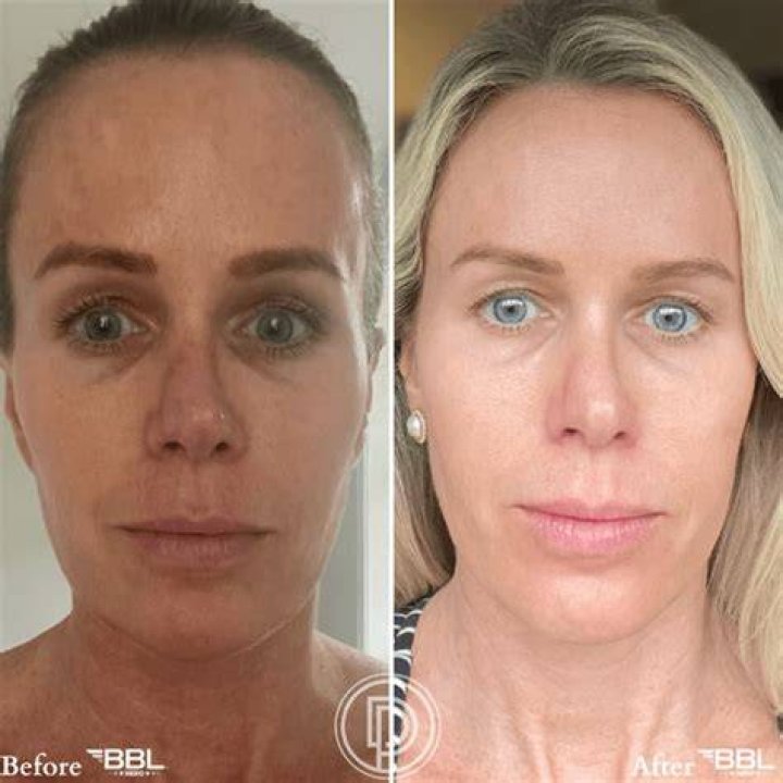 Erica Fontaine BBL Surgery: Before And After Photos