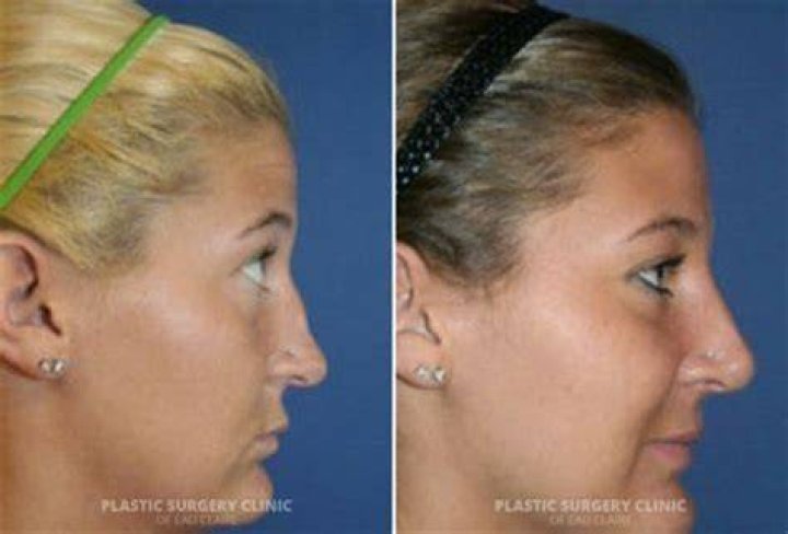 Herlene Nicole Budol New Look and Nose After Rhinoplasty, Before And After Plastic Surgery Photos