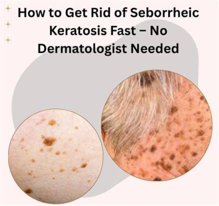 How to get rid of seborrheic keratosis