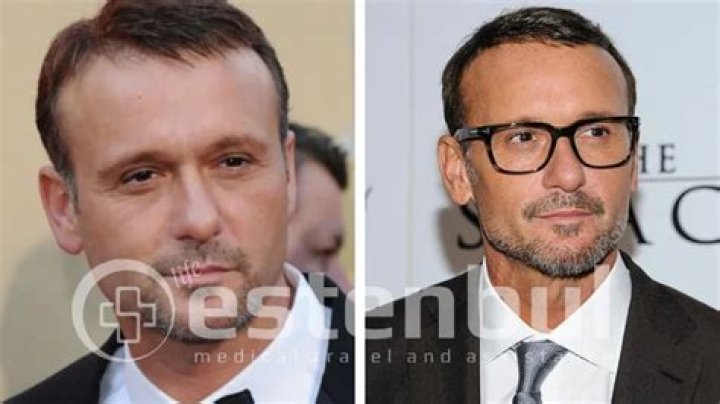 Is Tim McGraw Bald? Photos – Before And After, What Happened To His Hair?