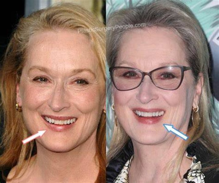 Meryl Streep Plastic Surgery Photos, Does She Have A Fake Teeth?