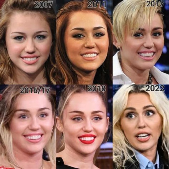 Miley Cyrus’ Plastic Surgery: The Singer Looks Different with a New Face; Speculations of Veneers, Nose Job, Buccal Fat Removal and More!